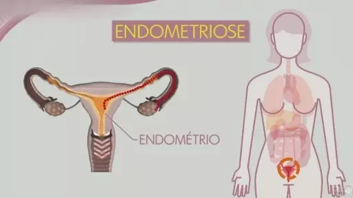 Endometriose: veja exige cuidados e o que é preciso fazer